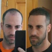 New Hair Italy Trapianto di Capelli Puglia Albania