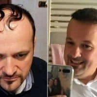 New Hair Italy Trapianto di Capelli Puglia Albania